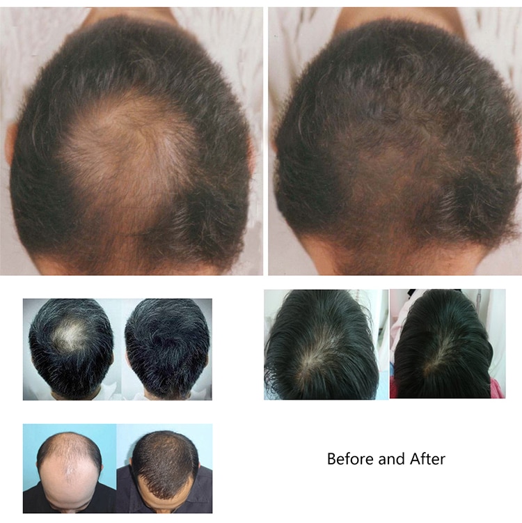 Laser Hair Growth Hairloss Treatment Helmet