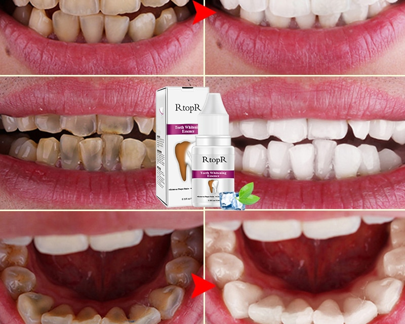 Teeth Whitening Kit Dental Cleanser