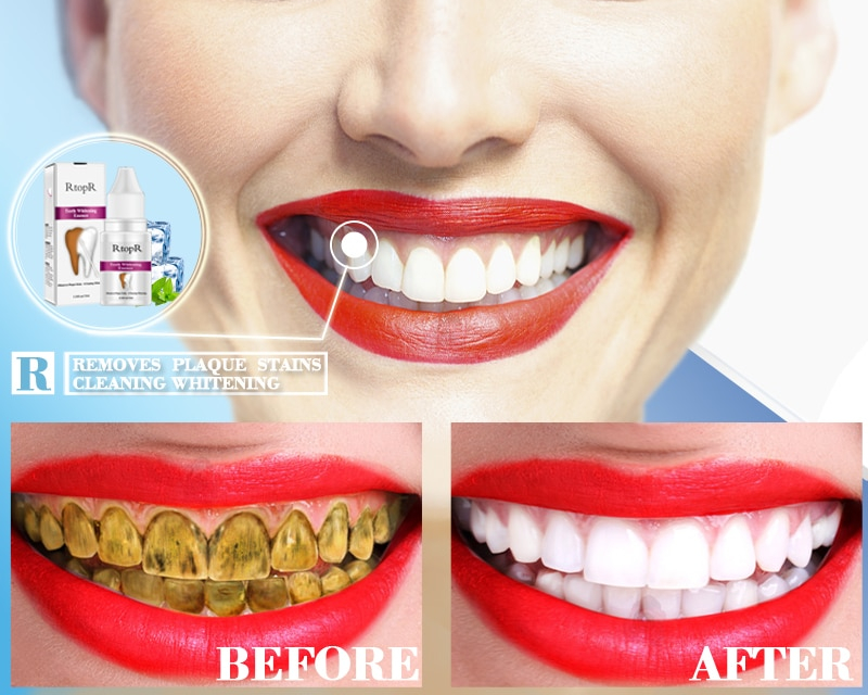 Teeth Whitening Kit Dental Cleanser