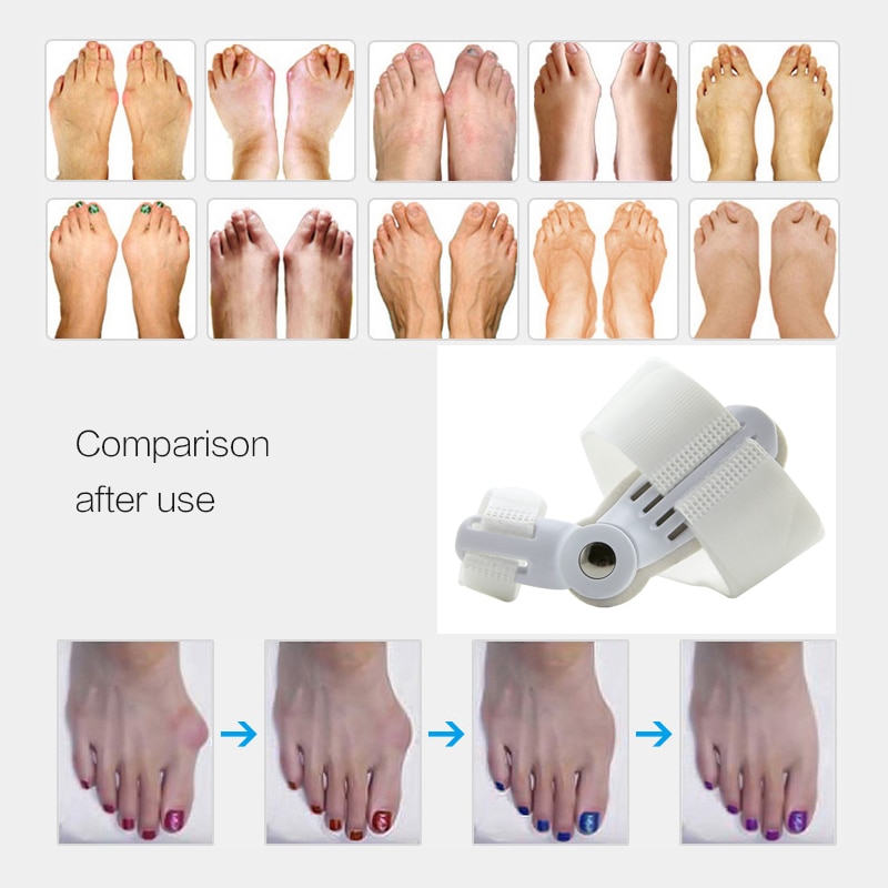 Toe Corrector Orthopedic Bone Straightener