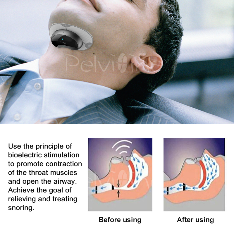 Anti-snoring Device Stopper