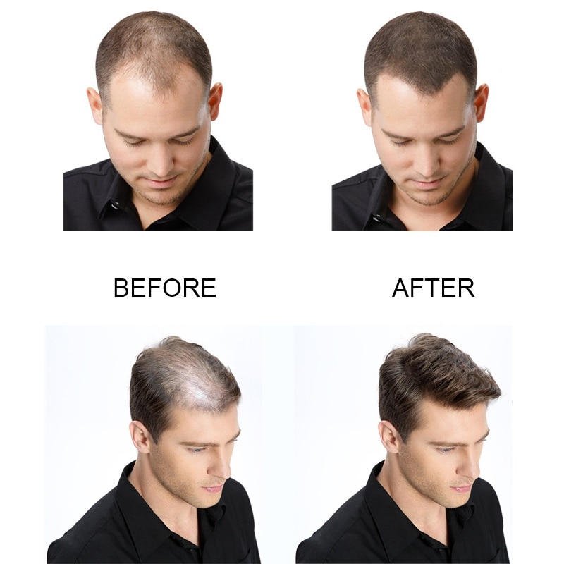 Hair Growth Spray Hair Loss Treatment