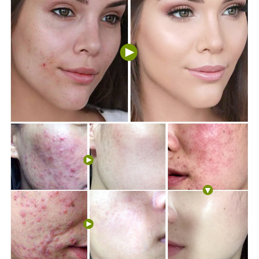 Acne Cream Facial Skin Care