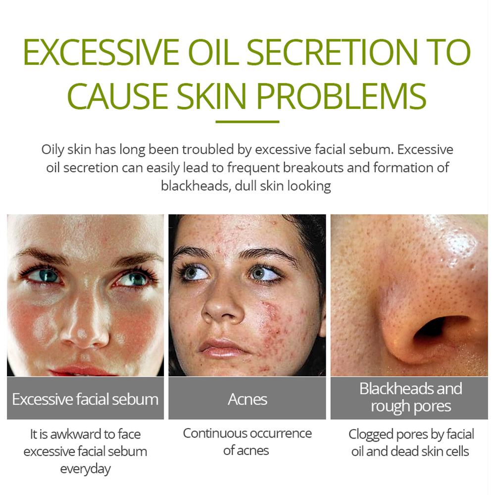 Acne Cream Facial Skin Care