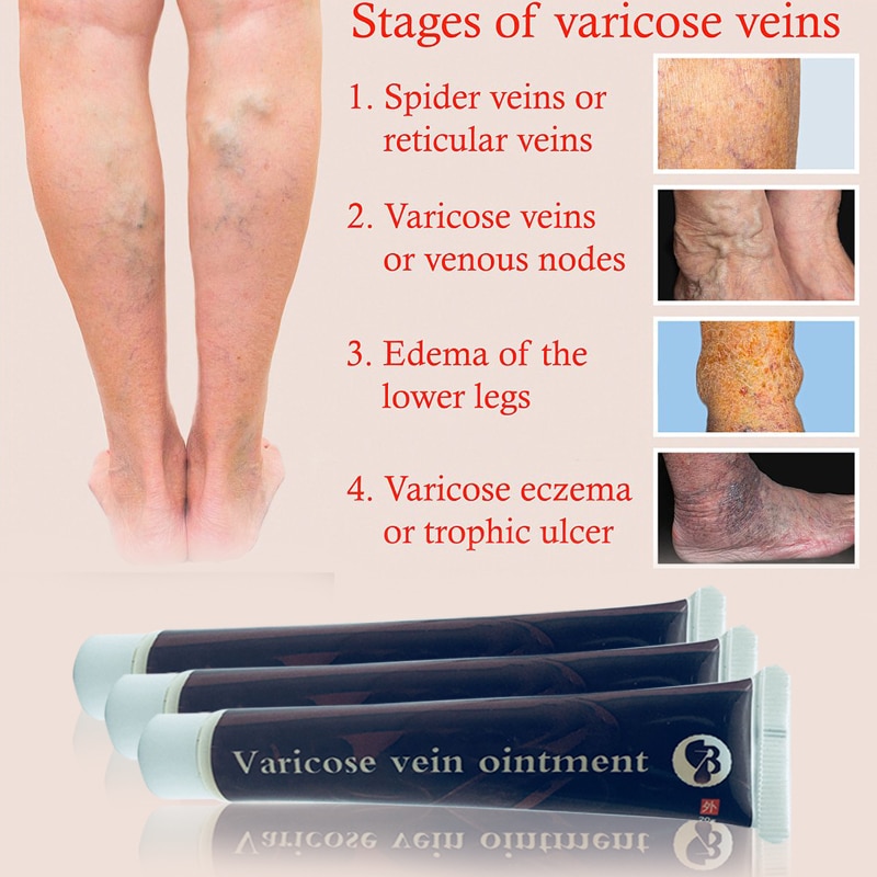 Varicose Veins Cream Ointment