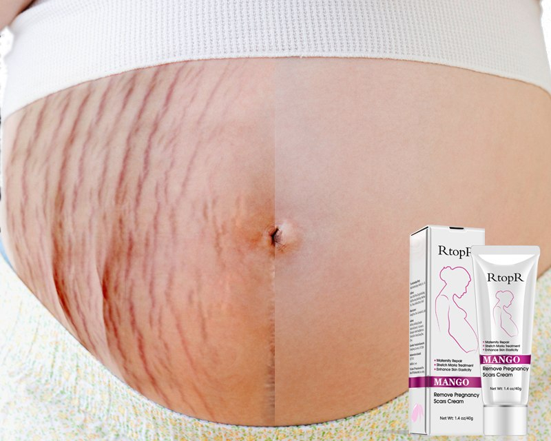 Pregnancy Stretch Mark Cream