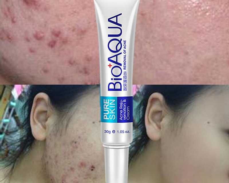 Whitening Cream Acne Treatment