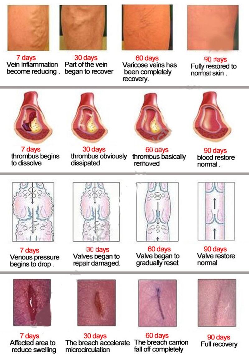 Varicose Veins Treatment Cream Herbal Formula