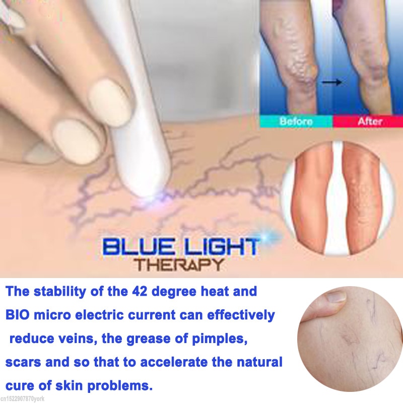 Blue Light Therapy Treatment Pen