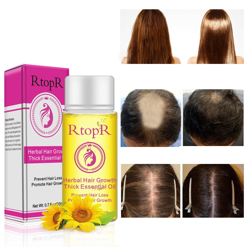 Herbal Hair Loss Treatment