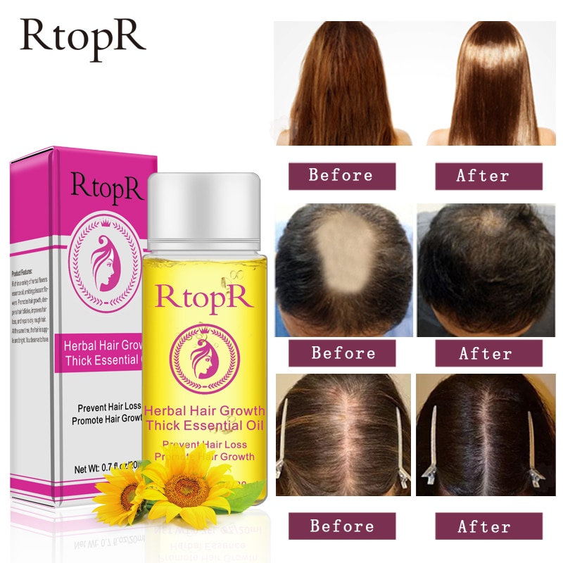 Herbal Hair Loss Treatment