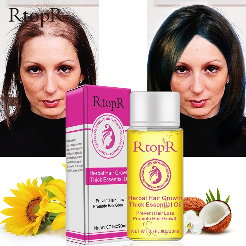 Herbal Hair Loss Treatment