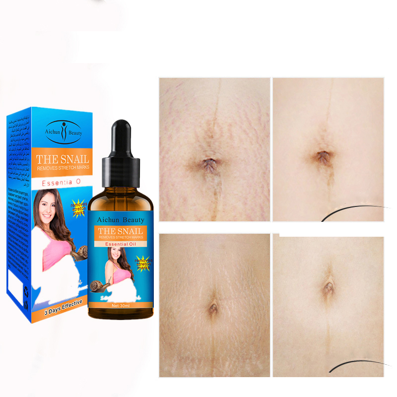 Maternity Stretch Mark Removal Essential Oil