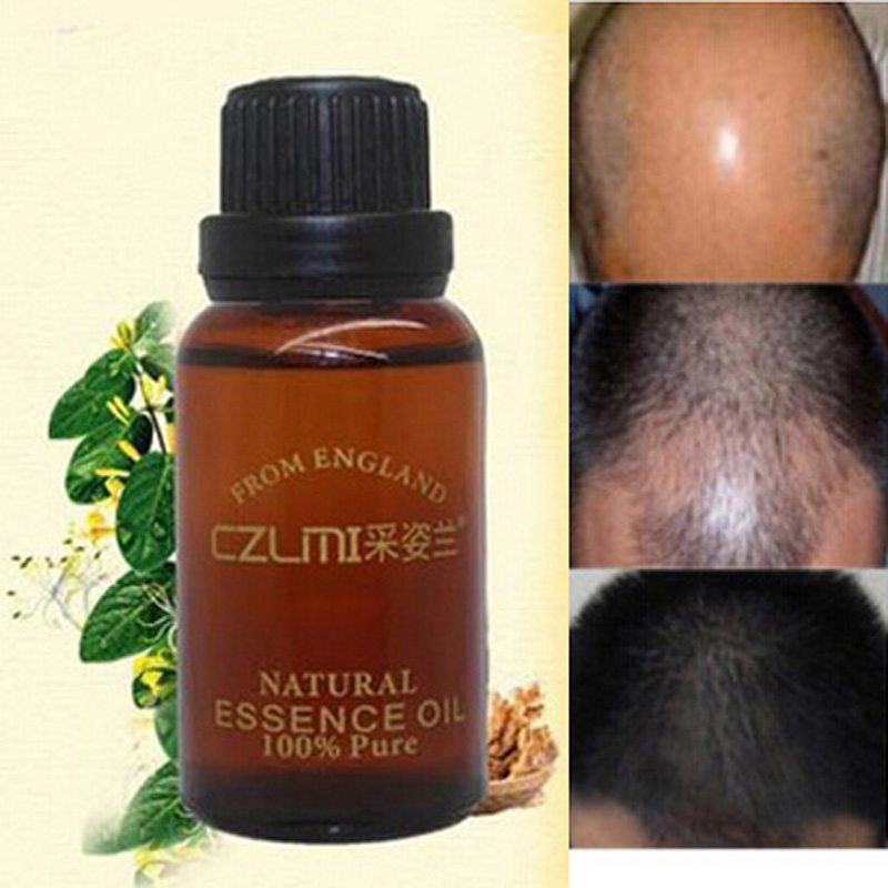 Alopecia Hair Loss Treatment