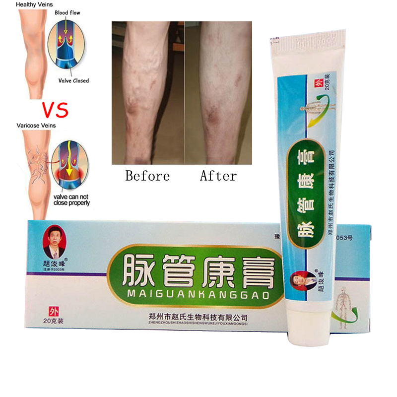 Varicose Veins Treatment Ointment