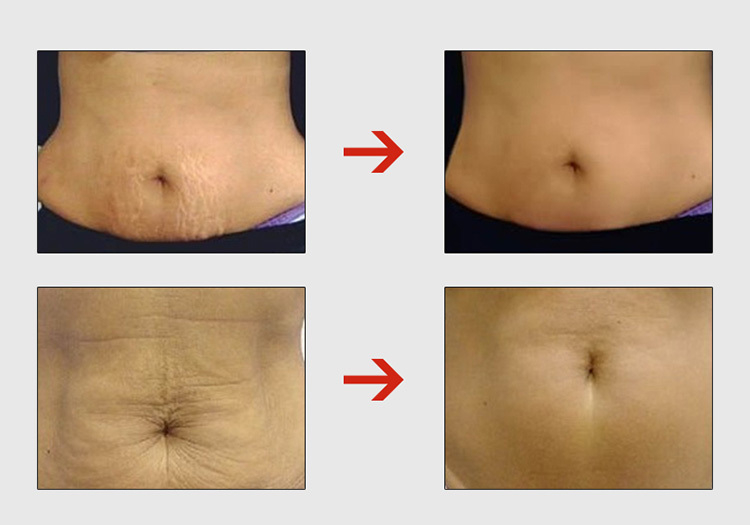 Stretchmark Removal Cream