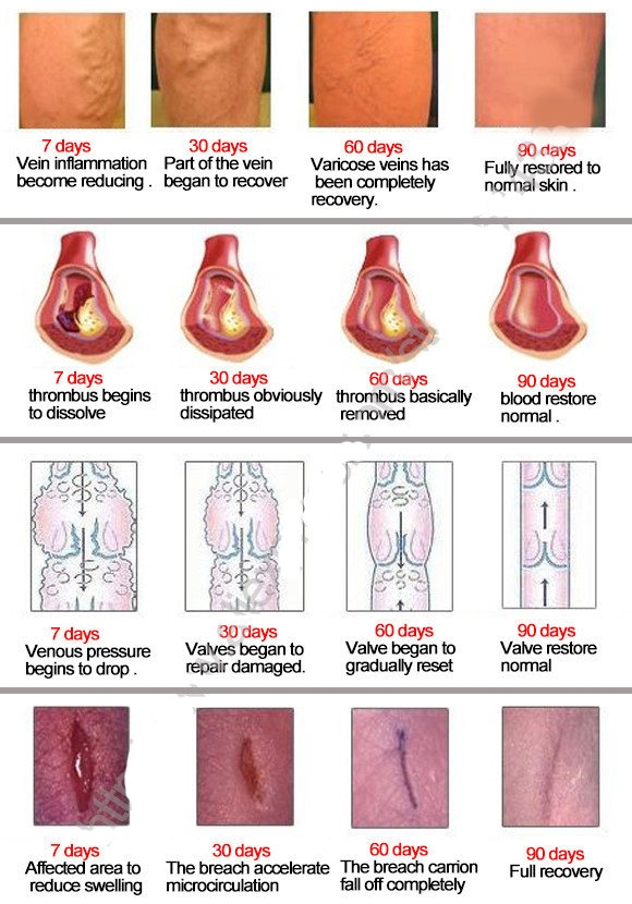 Varicose Veins Treatment Plaster (Set of 24)