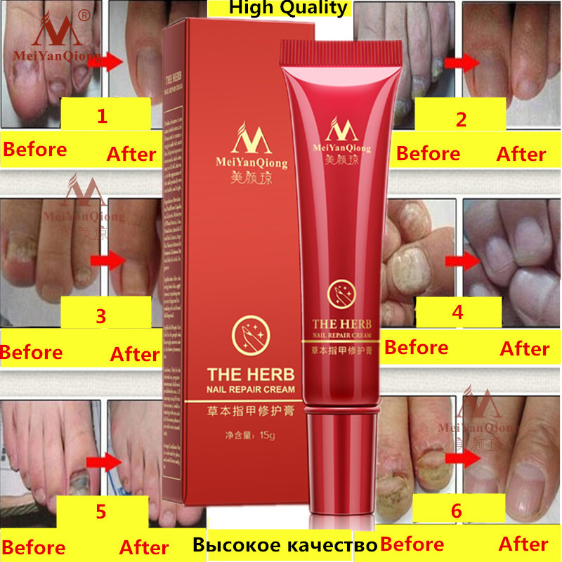 Herbal Antifungal Nail Treatment Cream