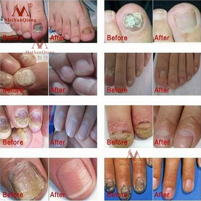 Herbal Antifungal Nail Treatment Cream