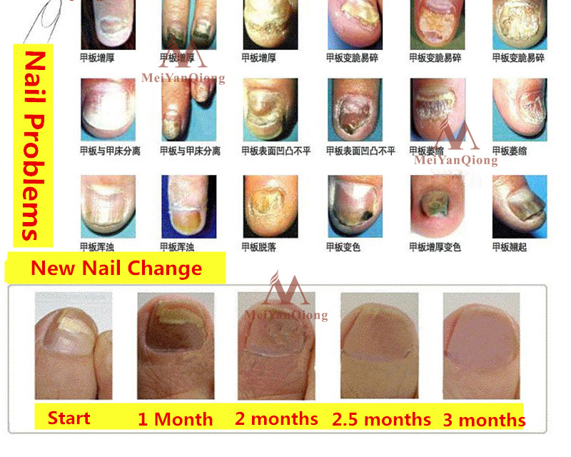 Herbal Antifungal Nail Treatment Cream