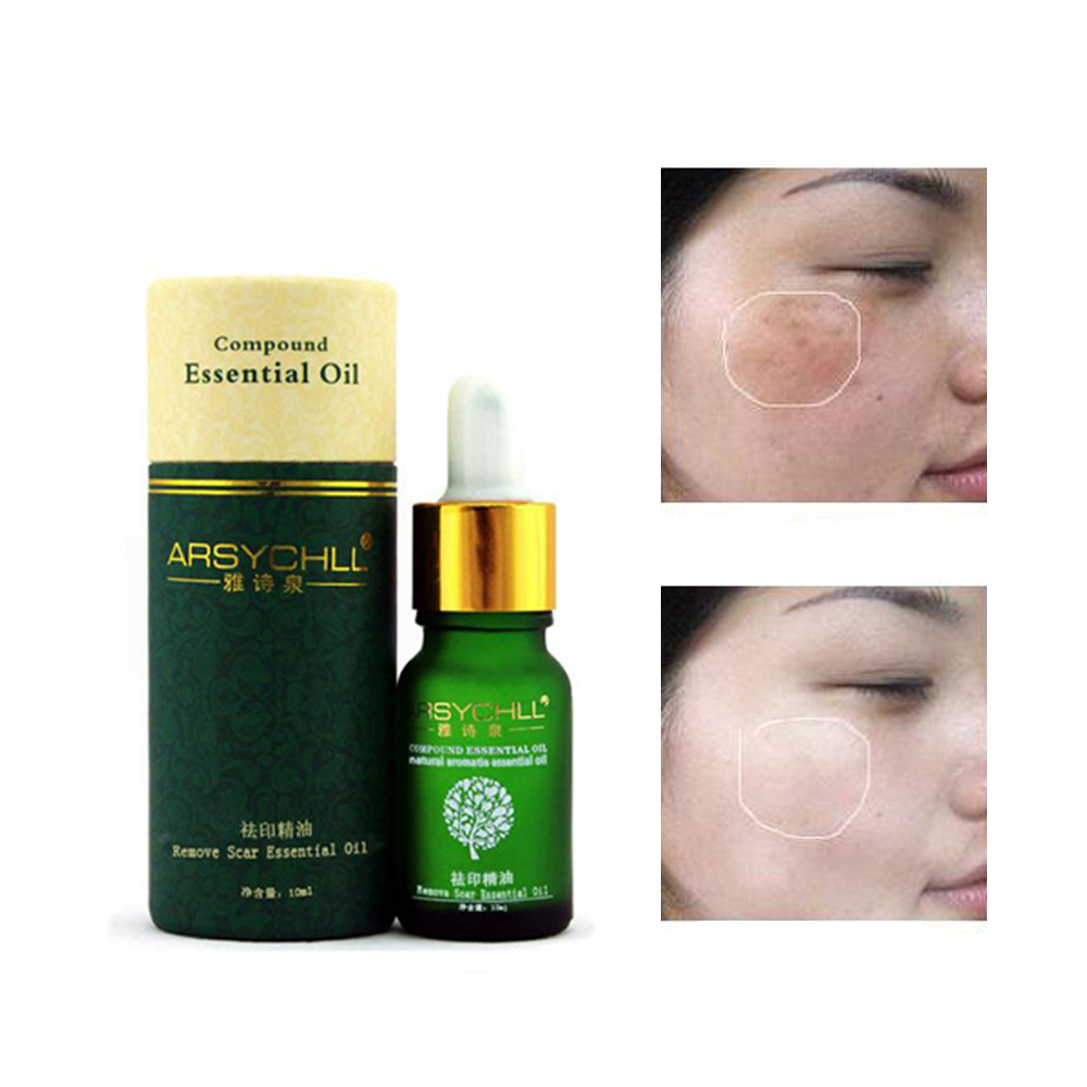 Natural Acne Scars Removal Home Remedy Oil