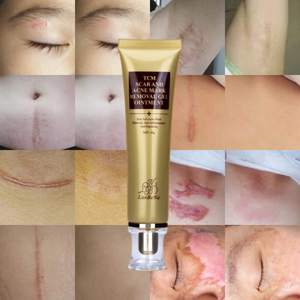 Acne & Scar Removal Cream
